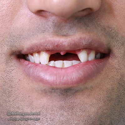 پروتز های دندانی8