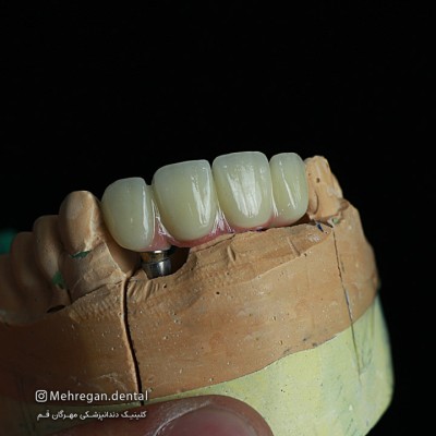 پروتز های دندانی10